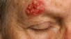Carcinoma epidermoide: Una amenaza silenciosa en la piel.