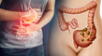 Descubre las señales que indican la presencia de divertículos en el colon.