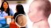 Todo sobre la microtia unilateral.