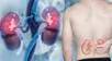Síntomas que indican riesgo de cáncer de riñón.