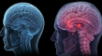 Cómo el aneurisma cerebral puede manifestarse con señales simples.