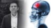 ¿Qué tan letales pueden ser las lesiones cerebrales?
