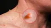 Expertos revelan cómo eliminar las verrugas en el cuello de manera natural.
