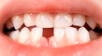 A qué edad tomar calcio para prevenir la pérdida dental.