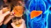 Qué sucede en tu hígado tras el consumo excesivo de alcohol.