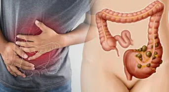 Divertículos en el colon: ¿qué son, cómo afectan y cómo tratarlos adecuadamente?