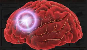 Así puedes prevenir el ictus, la amenaza silenciosa que cambia tu vida en minutos