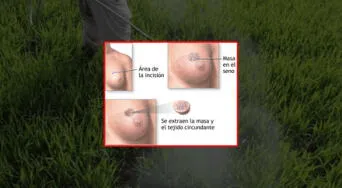 Cáncer y pesticidas: lo que la ciencia ya no puede seguir ocultando