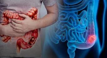 Detectan bacteria intestinal vinculada al cáncer colorrectal en jóvenes, según estudio en EE.UU.