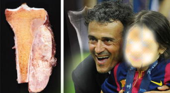 Osteosarcoma: la enfermedad que causó la muerte de la hija de Luis Enrique, entrenador del PSG
