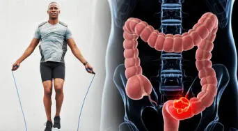 Estudio confirma que el ejercicio ayuda en la recuperación del cáncer de colon