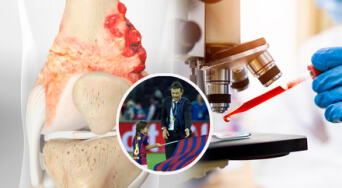 Científicos españoles identifican los factores que impulsan el cáncer óseo que afectó a la hija de Luis Enrique