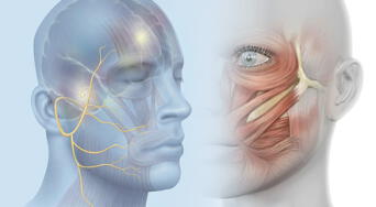 ¿Qué provoca la parálisis facial? Claves para entender esta condición neurológica