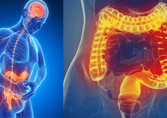 Alerta médica: la enfermedad inflamatoria intestinal que suma 10.000 casos por año
