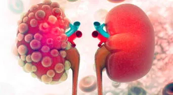 Insuficiencia renal: los síntomas que podrías estar ignorando y cómo detectarla a tiempo