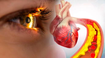 ¡Cuidado! Estas señales en los ojos podrían indicar colesterol alto