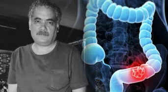 Cáncer de colon: la enfermedad que causó la muerte del actor Óscar Carrillo y qué señales no deben ignorarse