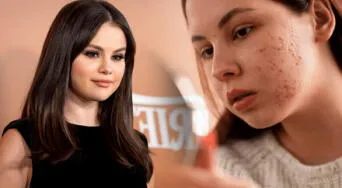 Selena Gomez revela cómo logró eliminar el acné de su rostro con eficacia