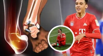 ¿Qué es una luxación de tobillo con fractura de peroné? El tipo de lesión que sufrió Jamal Musiala en el Mundial de Clubes