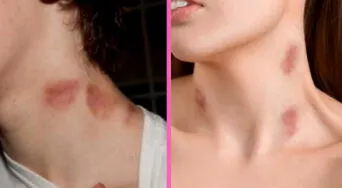 Chupetones en el cuello: plantas naturales que podrían ayudar a borrarlos más rápido, según expertos