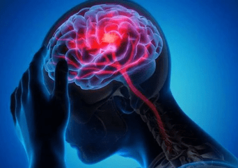 ¡No las ignores! Las señales que tu cuerpo te da un mes antes de sufrir un derrame cerebral
