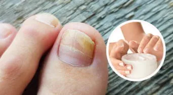 Cómo eliminar hongos en las uñas de los pies de forma rápida y efectiva: lo que realmente funciona