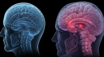 Aneurisma cerebral: el enemigo silencioso detrás de un dolor de cabeza común