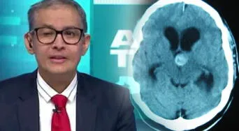 Aneurisma cerebral e hidrocefalia: la grave condición que afectó a Erick Osores y comenzó con un dolor de cabeza