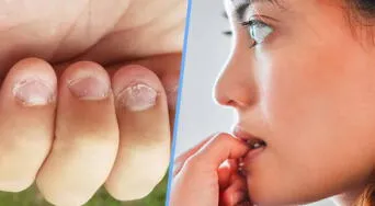¿Por qué algunas personas se muerden las uñas? Esto dice la psicología