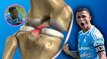 ¿Qué es la rotura de ligamentos cruzados y cómo se recupera? La dura lesión que alejó a Yoshimar Yotún por 15 meses de Sporting Cristal
