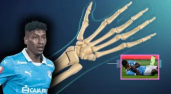 ¿Qué es la fractura de radio distal, causas y cómo prevenirla? Lesión que sufrió Miguel Araujo en el Sporting Cristal vs. Alianza Lima