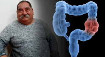 ¿Qué tan letal es el cáncer de colon? La enfermedad que enfrenta el actor Ramón García