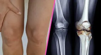 Artrosis de rodilla: el método que podría aliviar el dolor y frenar la degeneración del cartílago sin pastillas ni cirugía, según especialistas