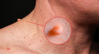 Verrugas en el cuello: cómo eliminarlas de forma segura y efectiva, según expertos