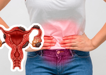 MINSA alerta: la enfermedad que afecta al 8 % de mujeres podría estar detrás de cólicos menstruales intensos
