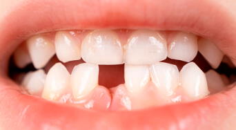 La edad ideal para comenzar a tomar calcio y prevenir la pérdida dental, según especialistas