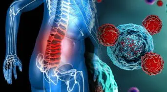 Nuevos avances médicos contra el mieloma múltiple, un cáncer que afecta a adultos mayores