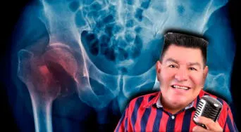 Dilbert Aguilar sufre grave accidente: qué es una fractura de cadera y cómo se trata