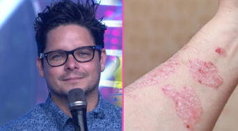 Gian Piero Díaz confiesa que enfrenta enfermedad crónica: qué es la psoriasis, síntomas, causas, tipos y tratamiento