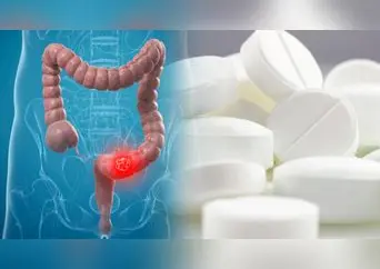 ¡Hay esperanza! Estudio revela que una aspirina diaria podría prevenir recaídas en cáncer de colon