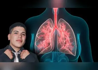 Atelectasia: qué es, síntomas, causas y tratamiento de la condición que afecta a Thiago Medina, ex Gran Hermano