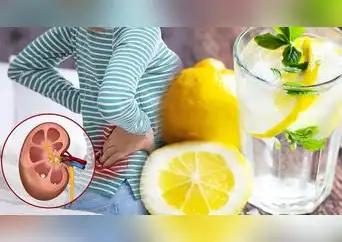 ¿Piedras en el riñón? Estas bebidas podrían ayudarte a prevenir los cálculos renales