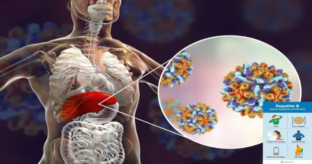 Las campañas de vacunación son fundamentales para prevenir la hepatitis A y B, especialmente en poblaciones vulnerables. Las campañas de vacunación son fundamentales para prevenir la hepatitis A y B, especialmente en poblaciones vulnerables.