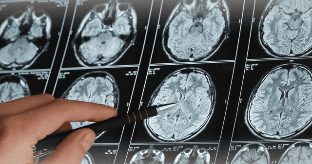 La prevención y el tratamiento oportuno son clave para reducir las secuelas de un derrame cerebral. La prevención y el tratamiento oportuno son clave para reducir las secuelas de un derrame cerebral.