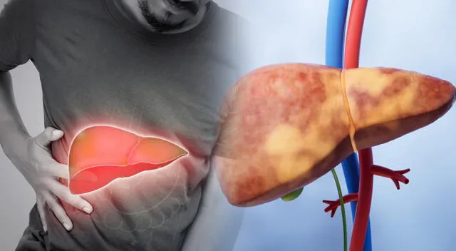 El hígado graso puede tener origen alcohólico o no alcohólico, y su presencia está relacionada directamente con los estilos de vida modernos. El hígado graso puede tener origen alcohólico o no alcohólico, y su presencia está relacionada directamente con los estilos de vida modernos.