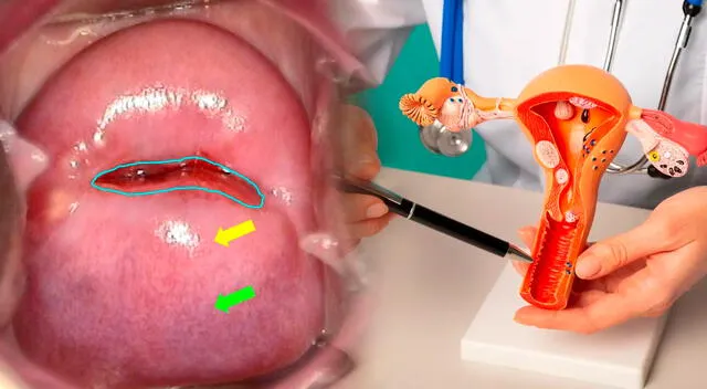 En el ámbito de la prevención, la vacunación contra el VPH es uno de los avances más significativos en la lucha contra el cáncer cervical. En el ámbito de la prevención, la vacunación contra el VPH es uno de los avances más significativos en la lucha contra el cáncer cervical.