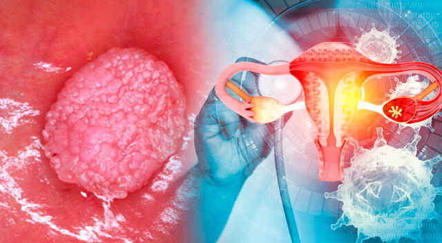 La vacunación contra el VPH es uno de los avances más significativos en la lucha contra el cáncer cervical. La vacunación contra el VPH es uno de los avances más significativos en la lucha contra el cáncer cervical.