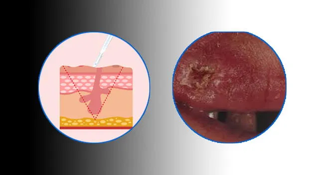 Conoce más sobre el carcinoma epidermoide. Foto: composición GLR/difusión Conoce más sobre el carcinoma epidermoide. Foto: composición GLR/difusión