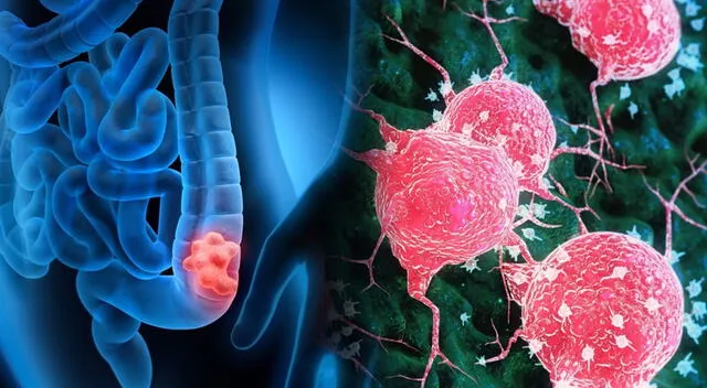La proteína clave identificada es la p53, considerada uno de los mayores aliados del cuerpo en la prevención del cáncer de colon. La proteína clave identificada es la p53, considerada uno de los mayores aliados del cuerpo en la prevención del cáncer de colon.