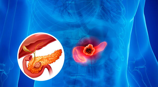 Utilizando células T modificadas para reconocer y atacar células tumorales específicas, los investigadores abren nuevas posibilidades para la lucha contra el cáncer de páncreas. Utilizando células T modificadas para reconocer y atacar células tumorales específicas, los investigadores abren nuevas posibilidades para la lucha contra el cáncer de páncreas.